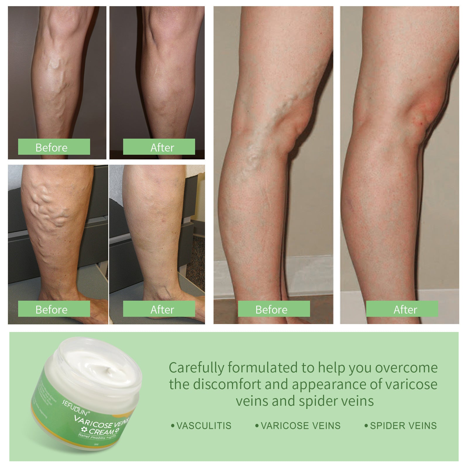 Skin Care Lotion Varicose Cream - Olive Eden